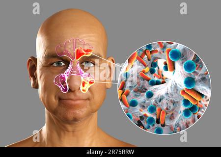 Sinusitis, inflammation of paranasal cavities. Computer illustration showing purulent inflammation of frontal and maxillary sinuses and close-up view Stock Photo