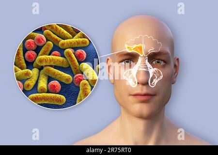 Sinusitis, inflammation of paranasal cavities. Computer illustration showing purulent inflammation of frontal sinus and close-up view of bacteria that Stock Photo