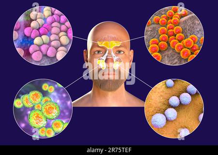 Rhinosinusitis in a man and bacteria that cause sinusitis. Streptococcus pneumoniae, Staphylococcus aureus, Moraxella catarrhalis, and Streptococcus p Stock Photo