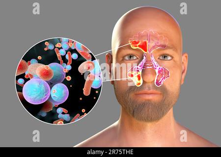 Sinusitis, inflammation of paranasal cavities. Computer illustration showing purulent inflammation of frontal and maxillary sinuses and close-up view Stock Photo