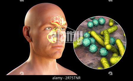 Sinusitis, inflammation of paranasal cavities. Computer illustration showing purulent inflammation of frontal and maxillary sinuses and close-up view Stock Photo