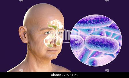 Sinusitis, inflammation of paranasal cavities. Computer illustration showing purulent inflammation of frontal and maxillary sinuses and close-up view Stock Photo