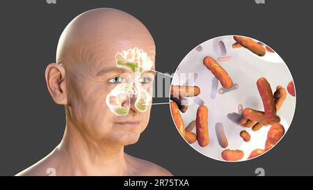 Pseudomonas aeruginosa bacteria as a cause of sinusitis. Computer illustration showing purulent inflammation of frontal and maxillary sinuses and clos Stock Photo