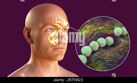 Streptococcus pyogenes bacteria as a cause of sinusitis. Computer illustration showing purulent inflammation of frontal, maxillary, and ethmoid sinuse Stock Photo