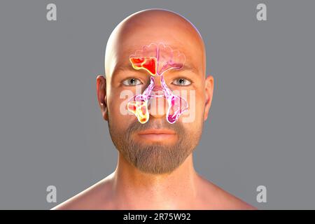 Viral sinusitis, computer illustration. The sinuses are membrane-lined ...