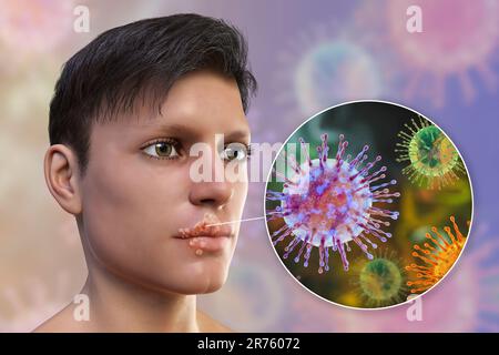 Cold sore on the lip of a man and closeup view of herpes simplex viruses, computer illustration. Cold sores are painful, fluid-filled blisters caused Stock Photo
