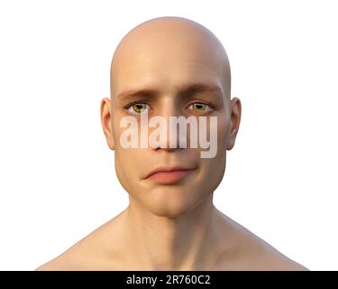 Bell's palsy, a unilateral facial paralysis, computer illustration. The condition is due to the inflammation of the facial nerve. It causes facial dro Stock Photo