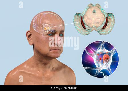 Substantia nigra. Computer illustration showing a degenerated substantia nigra in Parkinson's disease. The substantia nigra plays an important role in Stock Photo