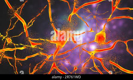 Destruction of neurons of Dorsal striatum, conceptual computer illustration. Dorsal striatum is a nucleus in the brain basal ganglia, its neurons are Stock Photo