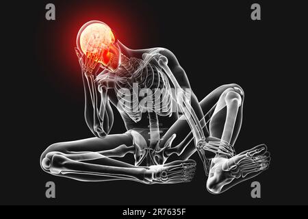 Headache, computer artwork. A male body with skeleton holding its head in pain. The red area in the skull represents the pain of a headache. Headaches Stock Photo