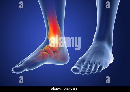 Painful ankle, computer illustration. Stock Photo