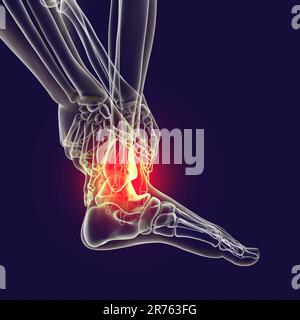 Painful ankle, computer illustration. Stock Photo