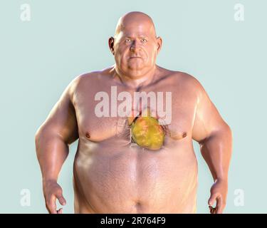 Computer illustration of a fatty heart in an overweight man. Stock Photo