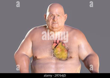 Computer illustration of a fatty heart in an overweight man. Stock Photo