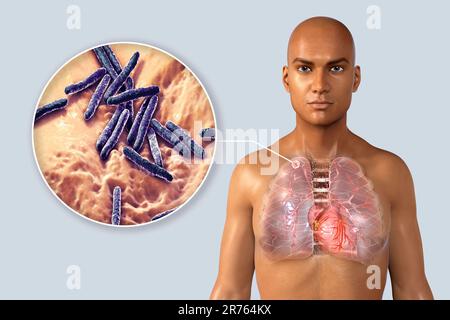 Secondary tuberculosis infection and close-up view of Mycobacterium tuberculosis bacteria, the causative agent of tuberculosis. Computer illustration Stock Photo