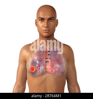 Lung cancer, computer illustration. Stock Photo