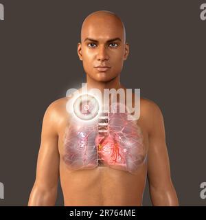 Secondary tuberculosis infection. Computer illustration showing small-sized solid nodular mass located in the upper lobe of right lung near lung apex. Stock Photo