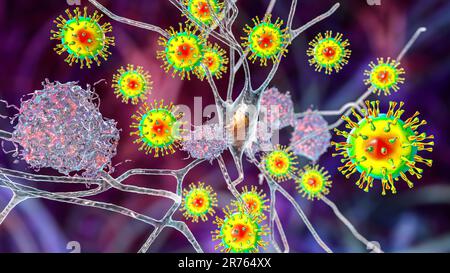 Infectious etiology of dementia, conceptual computer illustration. Neuropsychiatric sequelae of Covid-19. Viruses infecting neurons and progressive im Stock Photo