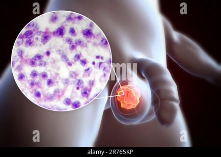 Testicular cancer, a malignant spermatocytic seminoma, computer illustration and light micrograph. A seminoma is a malignant tumour (cancer) of the te Stock Photo