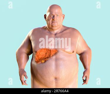 Fibrotic liver in obese man, computer illustration. Stock Photo