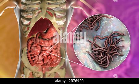 Round worms in human intestine, computer artwork. Roundworms, or nematodes, include numerous free-living and pathogenic species. Nematodes that common Stock Photo