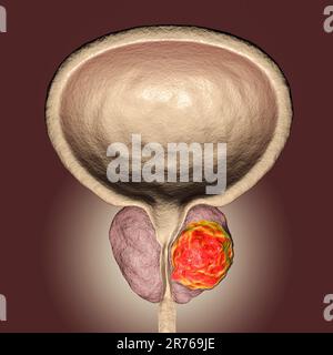 Prostate cancer. Computer artwork of a cancerous tumour (centre right) in the prostate gland (white, centre). The urethra can be seen running down the Stock Photo