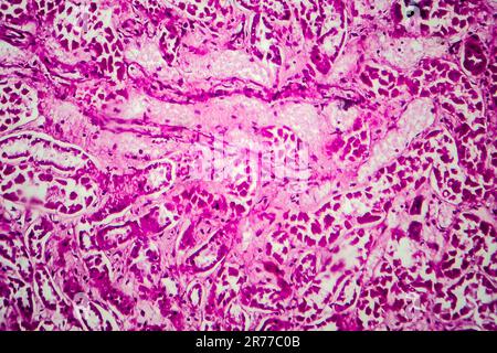 Glomerulonephritis. Light micrograph of tissue from a kidney in a case ...