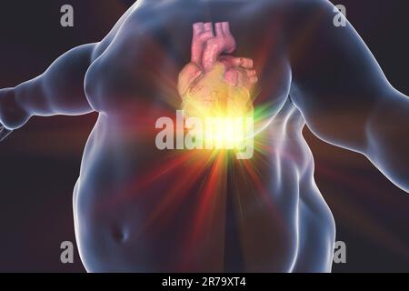 Heart attack in a person with obesity, conceptual image. 3D illustration Stock Photo