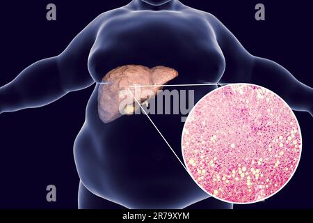 Obese man with fatty liver, 3D illustration and photomicrograph of liver steatosis. Conceptual image for non-alcoholic fatty liver disease Stock Photo