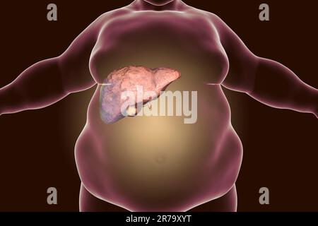 Obese man with fatty liver, 3D illustration. Conceptual image for non-alcoholic fatty liver disease Stock Photo