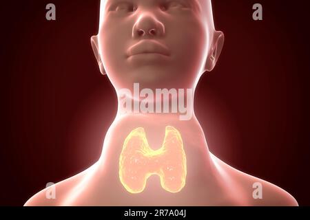 Toxic diffuse goiter, Flajani-Basedow-Graves' disease. 3D illustration showing enlarged thryoid gland in a female with hyperthyroidism Stock Photo