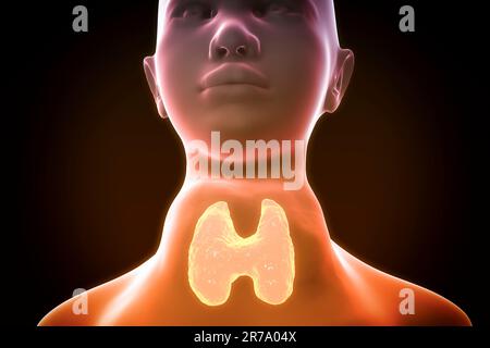 Toxic diffuse goiter, Flajani-Basedow-Graves' disease. 3D illustration showing enlarged thryoid gland in a female with hyperthyroidism Stock Photo