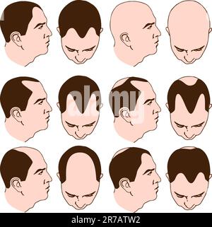 An image of man with various receding hairlines. Stock Vector