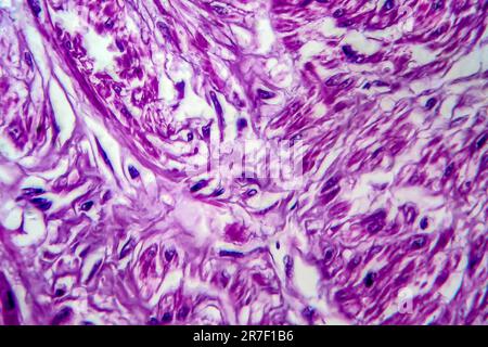 Uterine fibroid. Light micrograph (LM) of a section through tissue from the uterus, in a case of a uterine fibroids (leiomyoma). A fibroid is a benign Stock Photo
