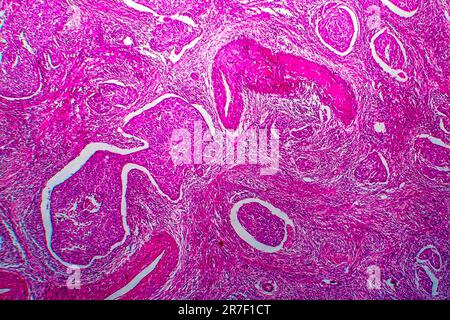 Cervical cancer. Light micrograph (LM) of a section through a squamous ...