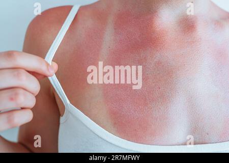 Swimsuit strap marks on young woman's sunburned skin Stock Photo