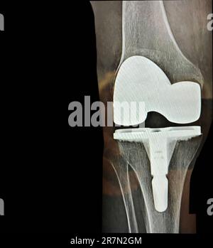 A total knee replacement in female Stock Photo