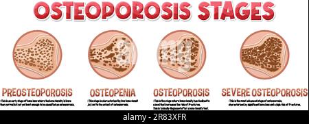 Informative poster of Osteoporosis human bone illustration Stock Vector