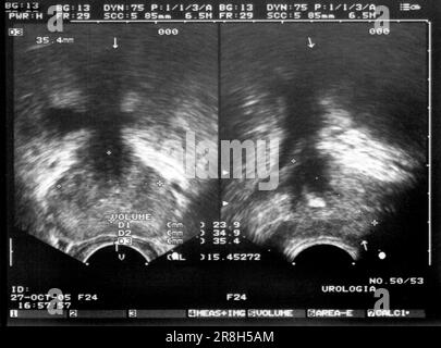 Ultrasound. Prostate Stock Photo