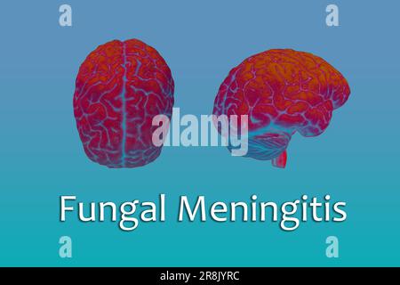 Background of fungal meningitis,Meningitis symptoms,Bacterial meningitis Stock Photo