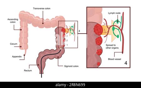 Medical diagram of colon cancer. scheme, anatomical illustration with cancer stages and spreading to other organs. Stock Vector