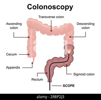 Colonoscopy technology concept with rendering endoscope inside of intestine. Medical diagram of colon with anatomical terms. Vector illustration Stock Vector