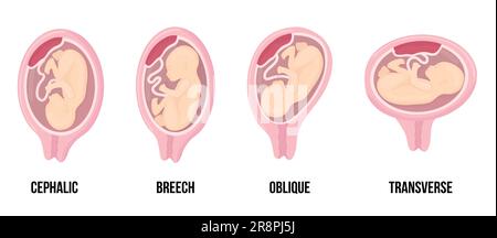 presentation cephalic uterus