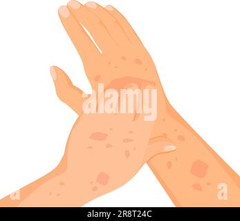 Rash skin on hand. Rashes itching hands scratch arm in red spot, dermatitis allergy symptoms itchy hives medicine pele virus eczema urticaria irritation disease vector illustration of skin disease Stock Vector