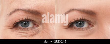 Woman looking better due to cosmetic procedures. Collage with photos before and after rejuvenation, closeup Stock Photo