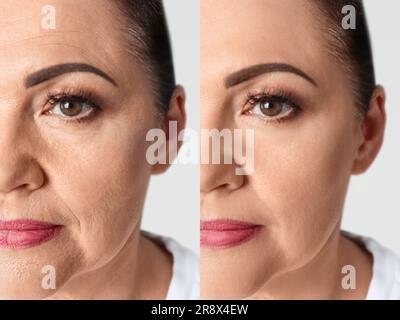 Woman looking better due to cosmetic procedures, closeup. Collage with photos on white background before and after rejuvenation Stock Photo