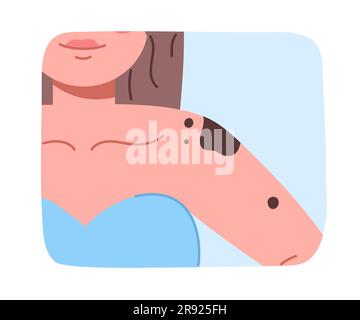 Woman with melanoma on shoulder concept Stock Vector