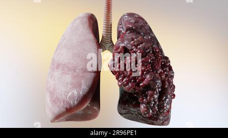 pneumonia and cigarette smoke Smoking-related interstitial pneumonia, frontal chest X-ray - Stock Image - C048/6082 Cigarette smoke exposure and alveolar