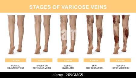Types Of Varicose Veins In Women Stages Of Development Of Varic Stock  Illustration - Download Image Now - iStock
