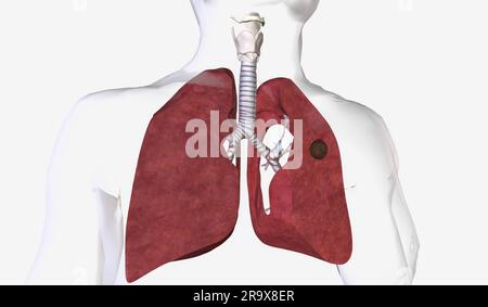 Pulmonary aspergilloma is a mass caused by a fungal infection that ...